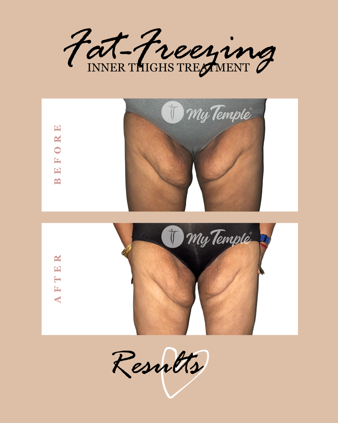 Inner thigh fat freezing results