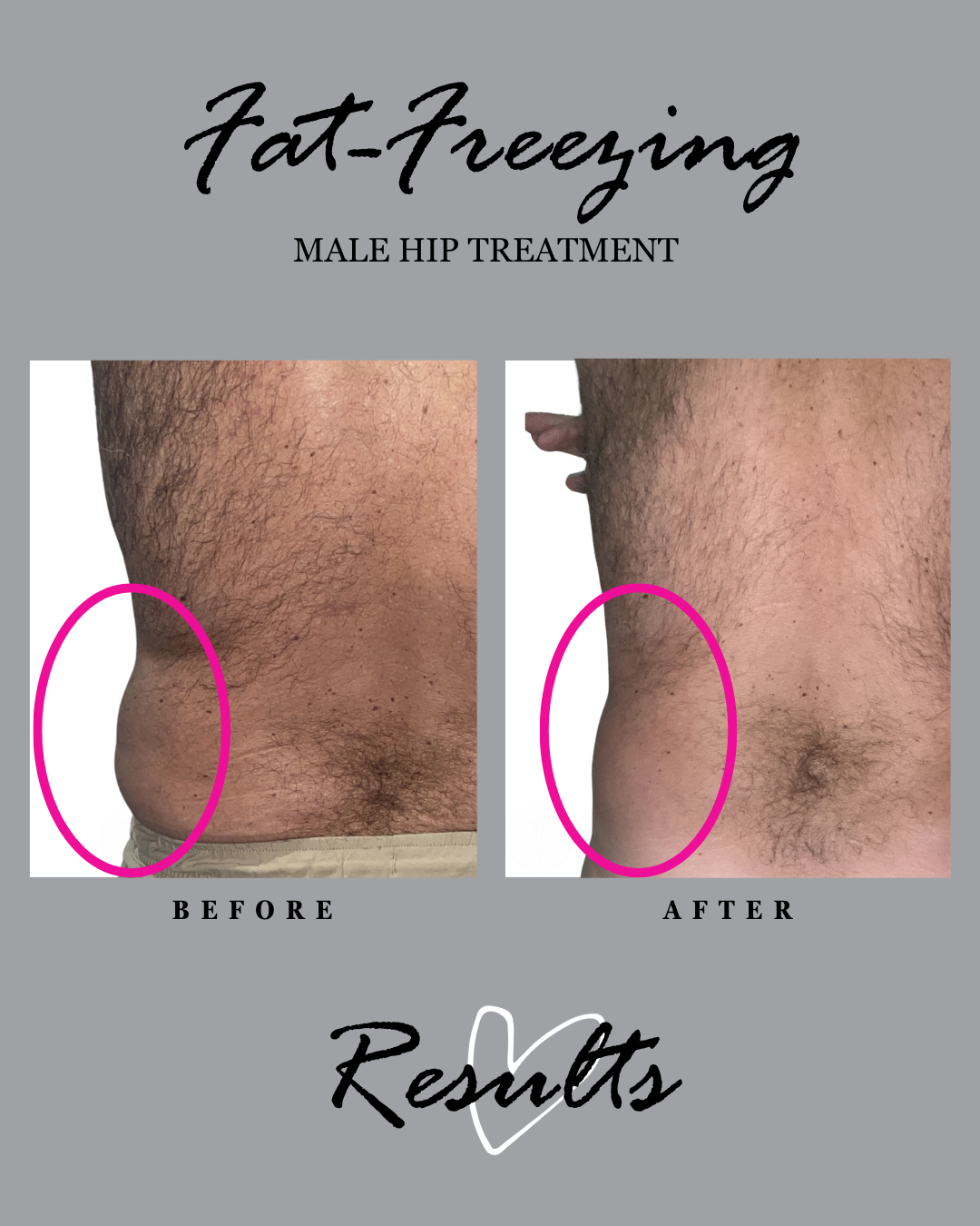 Fat freezing results: male hip, back view before and after.