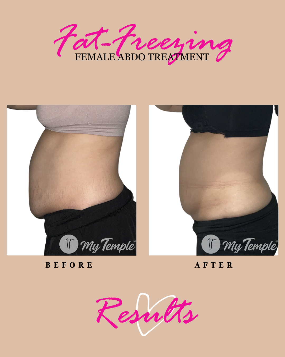 Fat freezing results: female abdomen treatment, before and after.