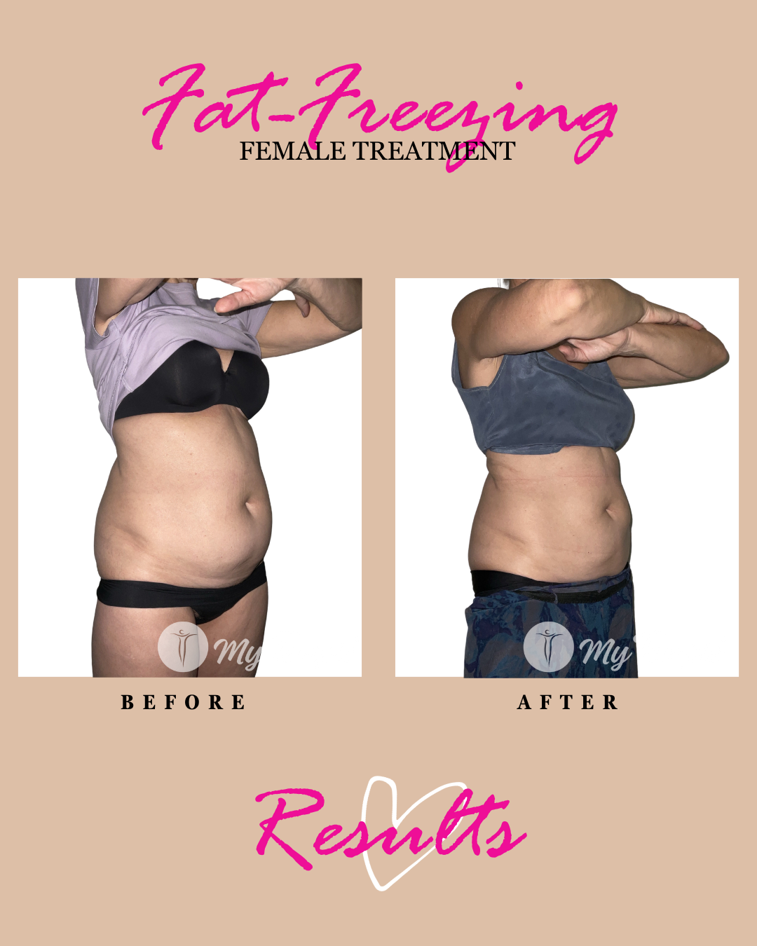 Fat freezing results: female abdomen treatment, before and after.