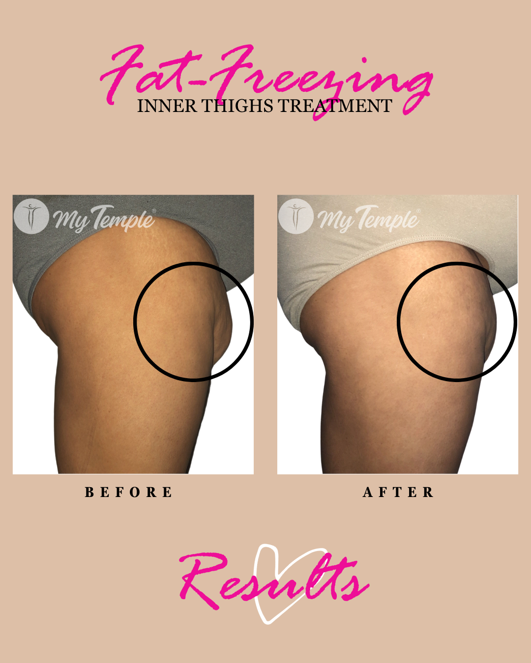 inner thighs women fat freezing