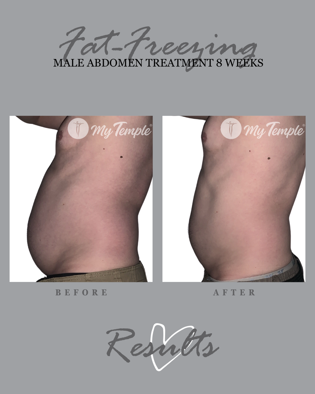 NH 8 weeks abdo x4x2 4x5 .png