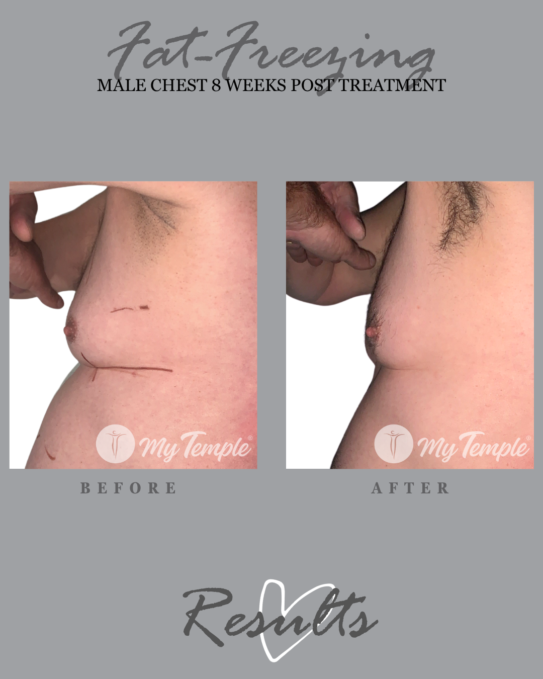 PP Male  TN 8 weeks chest and abdo 23.png