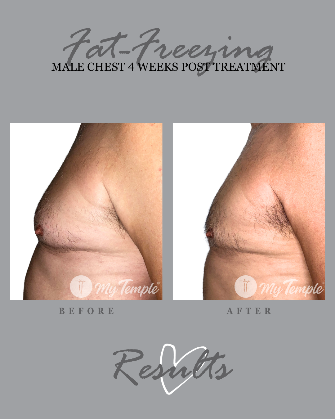 fat freezng results mans boobs