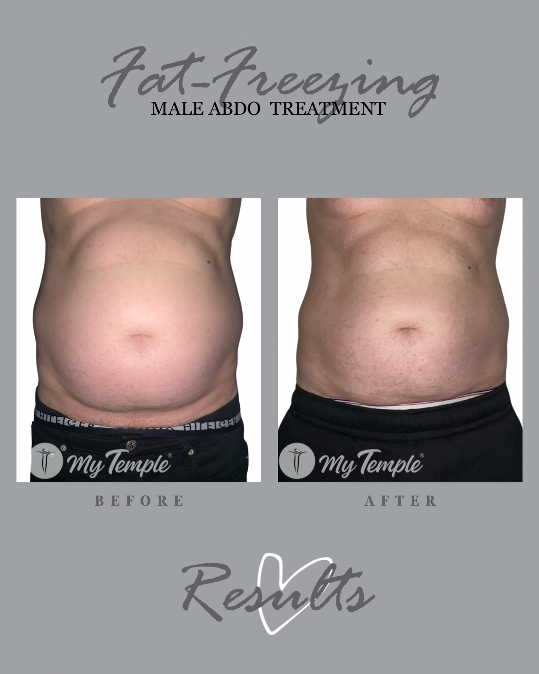 FAT FREEZING ON MENS ABDOMEN