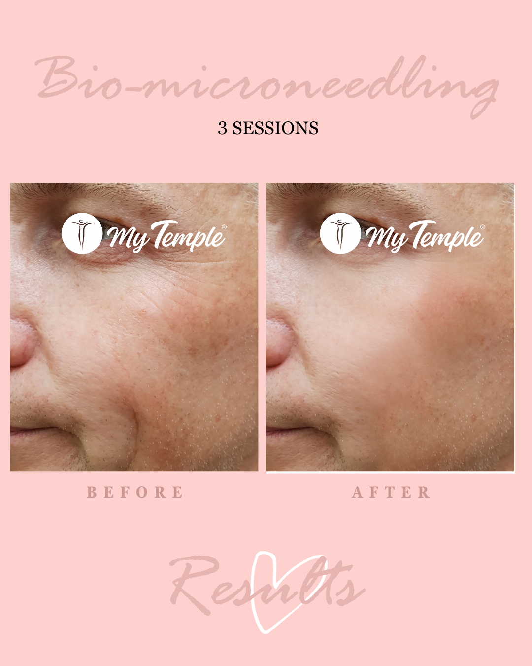 Natural microneedling alternative creating microchannels for deep product absorption