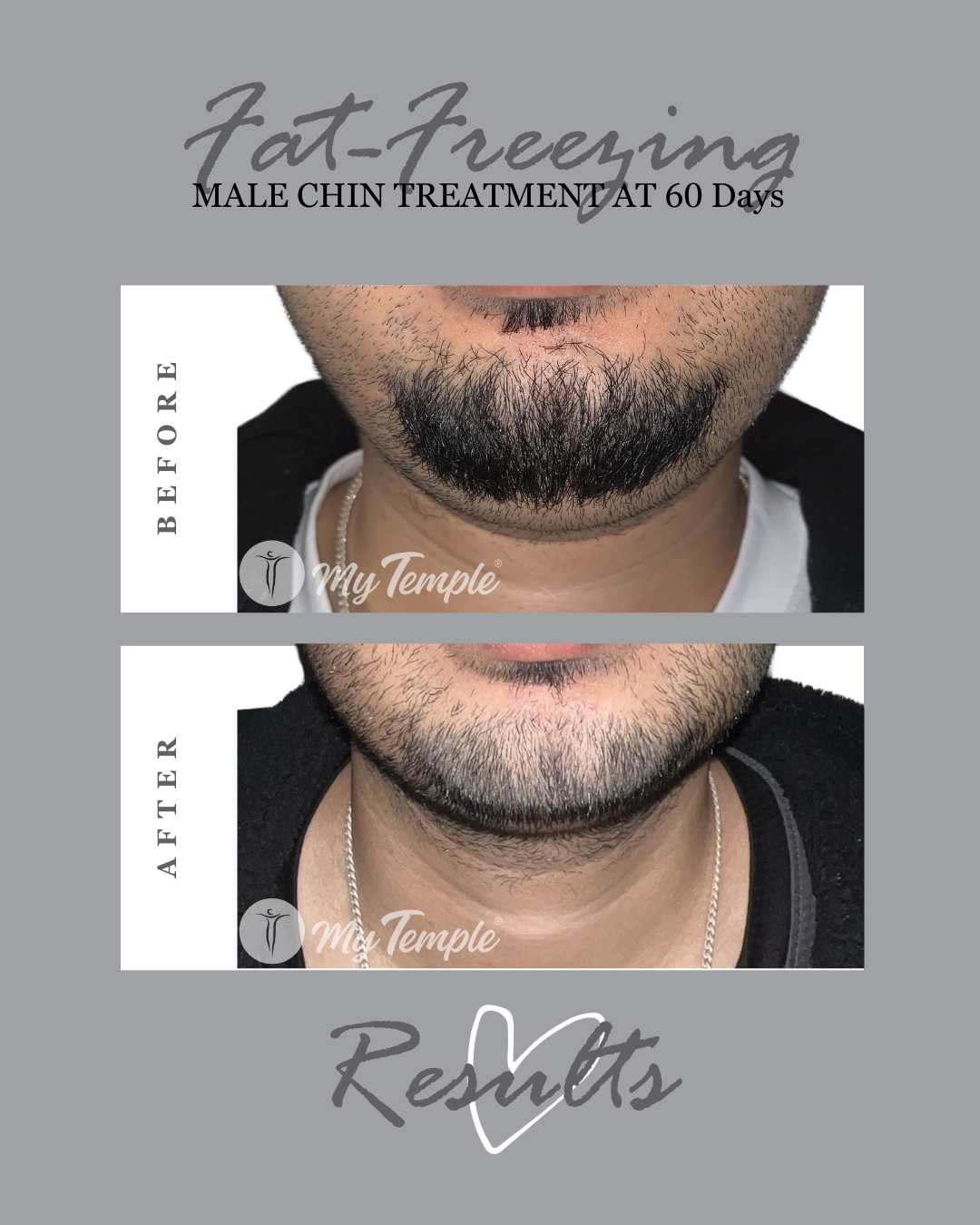_Sahil S chin 60 days .png