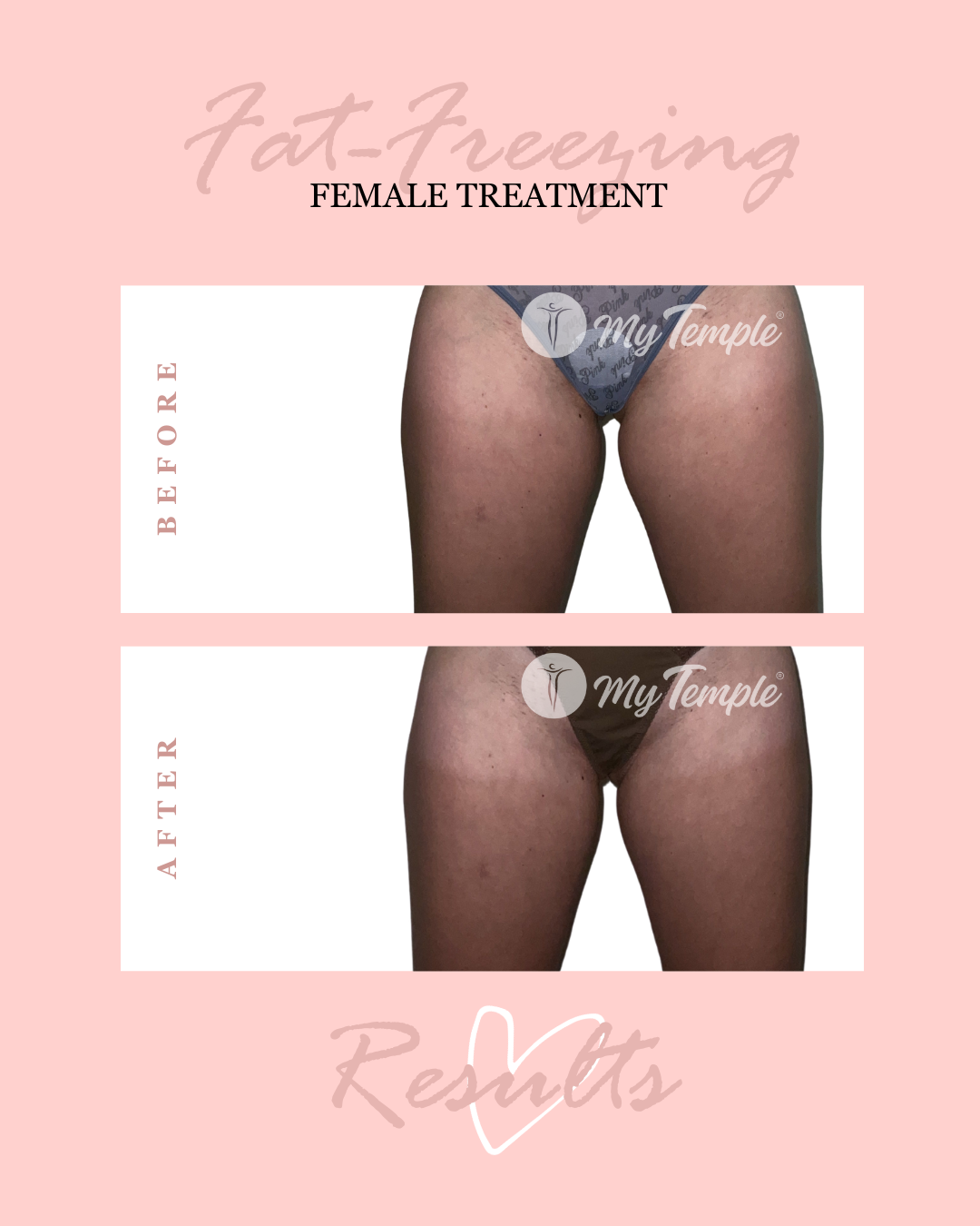 AR inner thighs and abdo (1).png