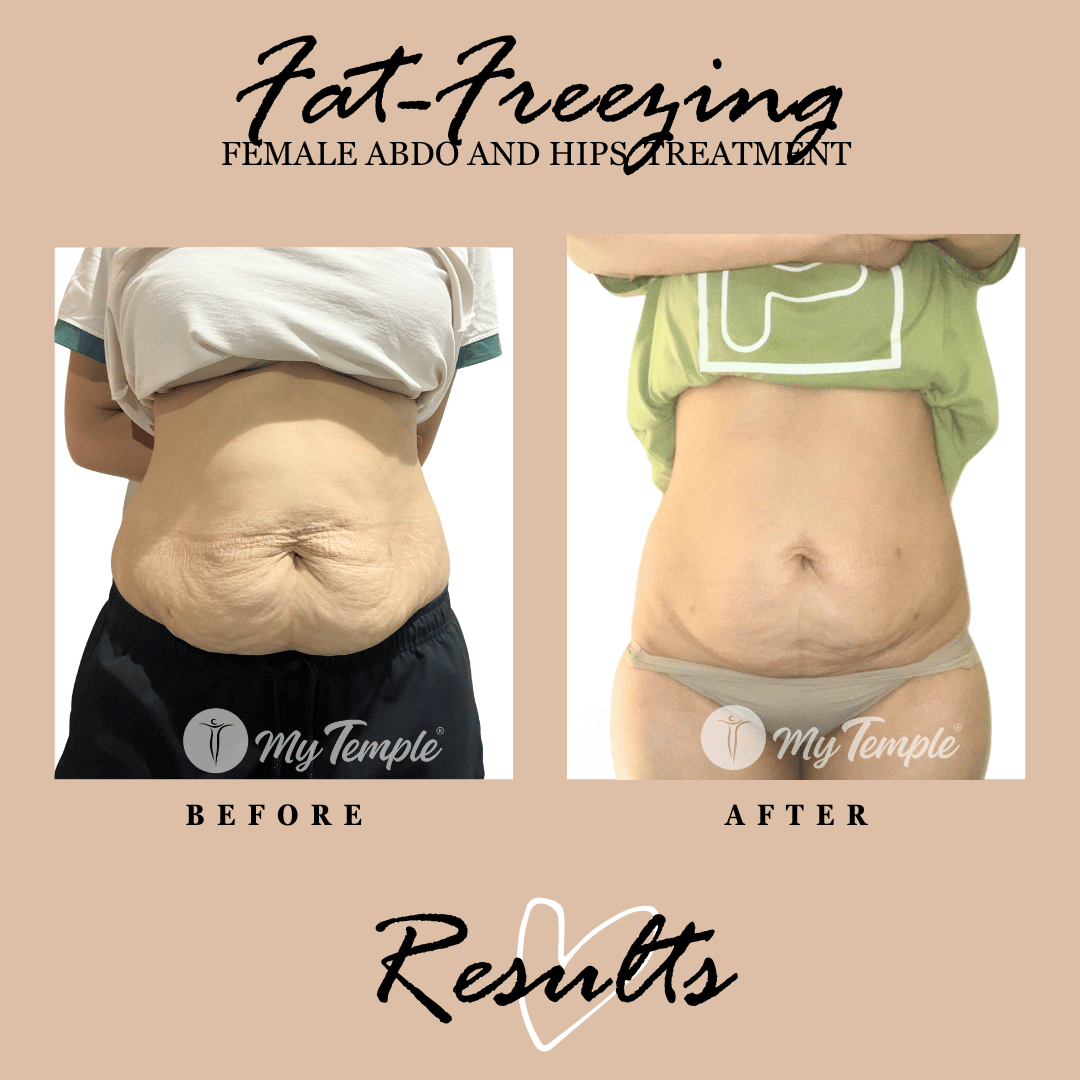 womens abdomen fat freezing result