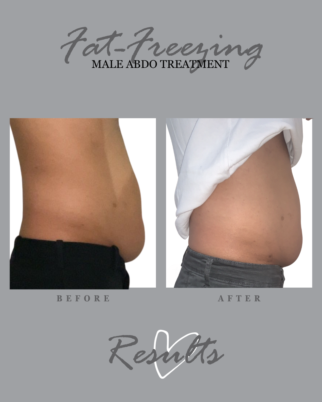 Fat freezing results: male hip, close-up before and after.