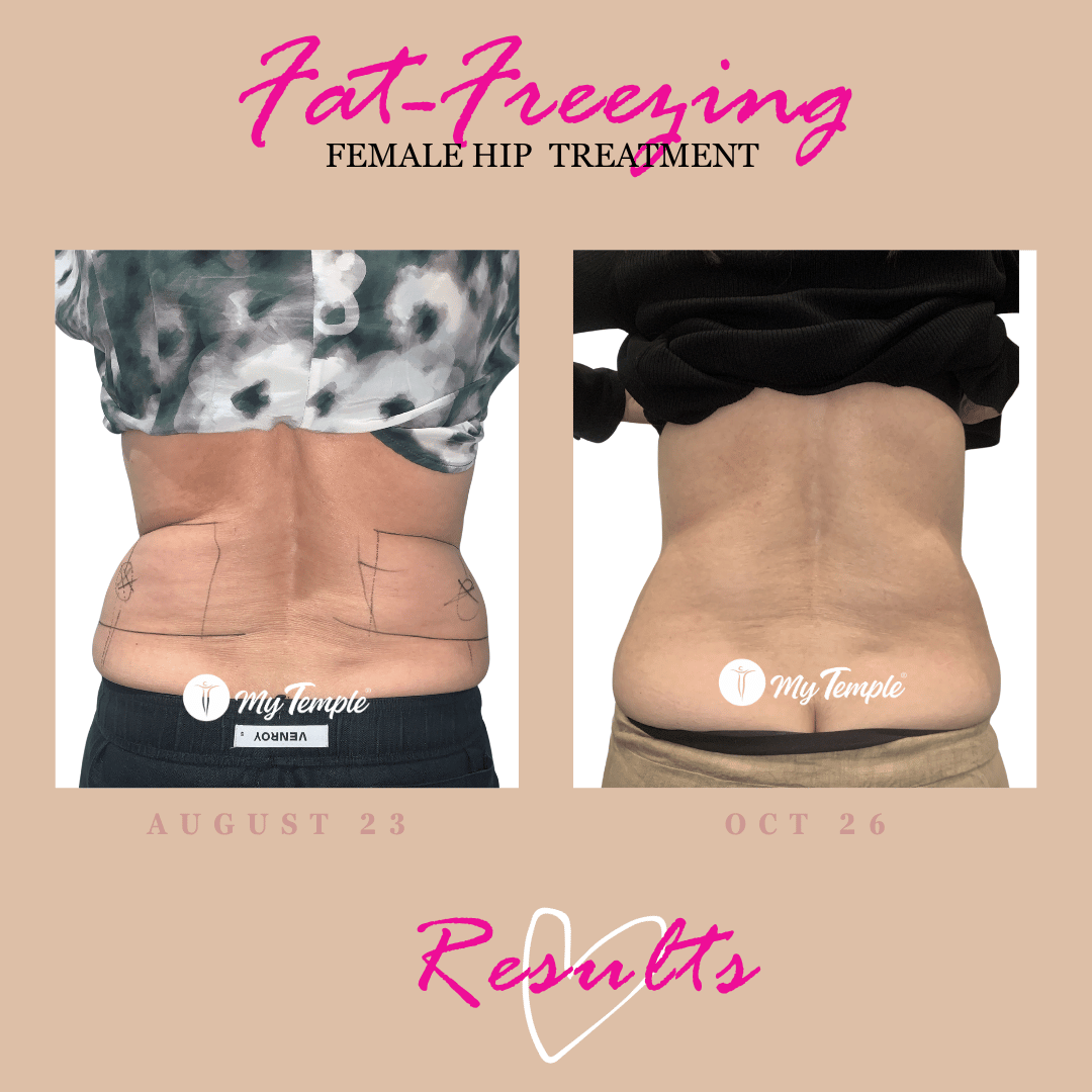 Long-term fat-freezing progress photo comparison showing the hips and lower back, August 2023 to October 2026.