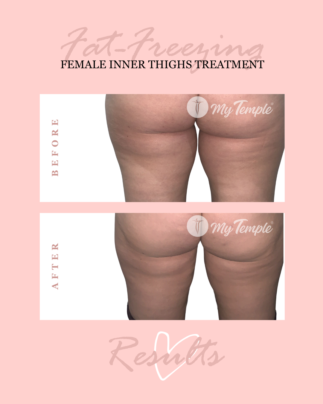 Nadia P inner thighs 4x5 (1).png