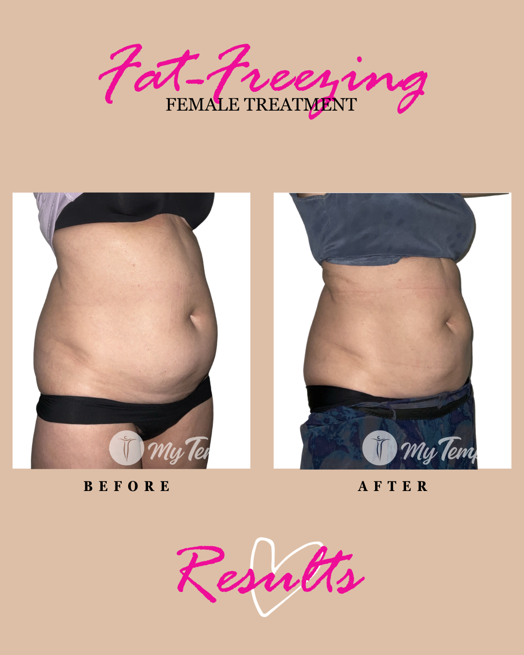 Fat freezing results: female abdomen treatment, before and after.