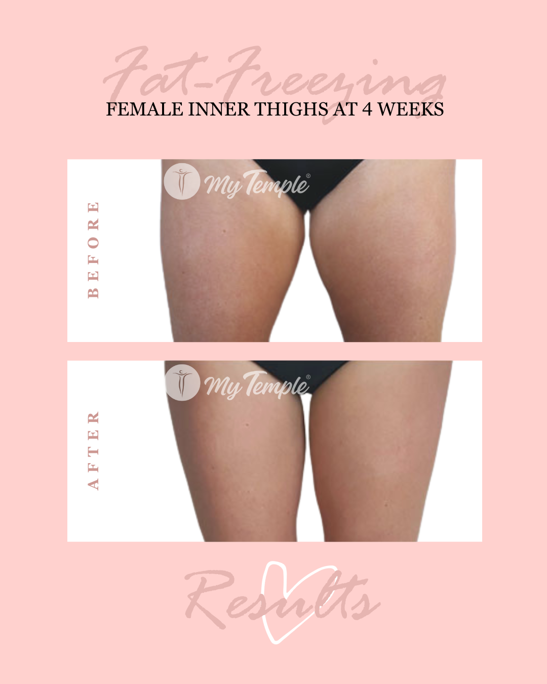 Inner thighs  (4x5).png