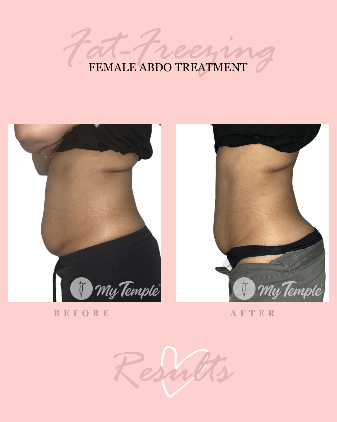 Josephine R lower abdo 4x5.png