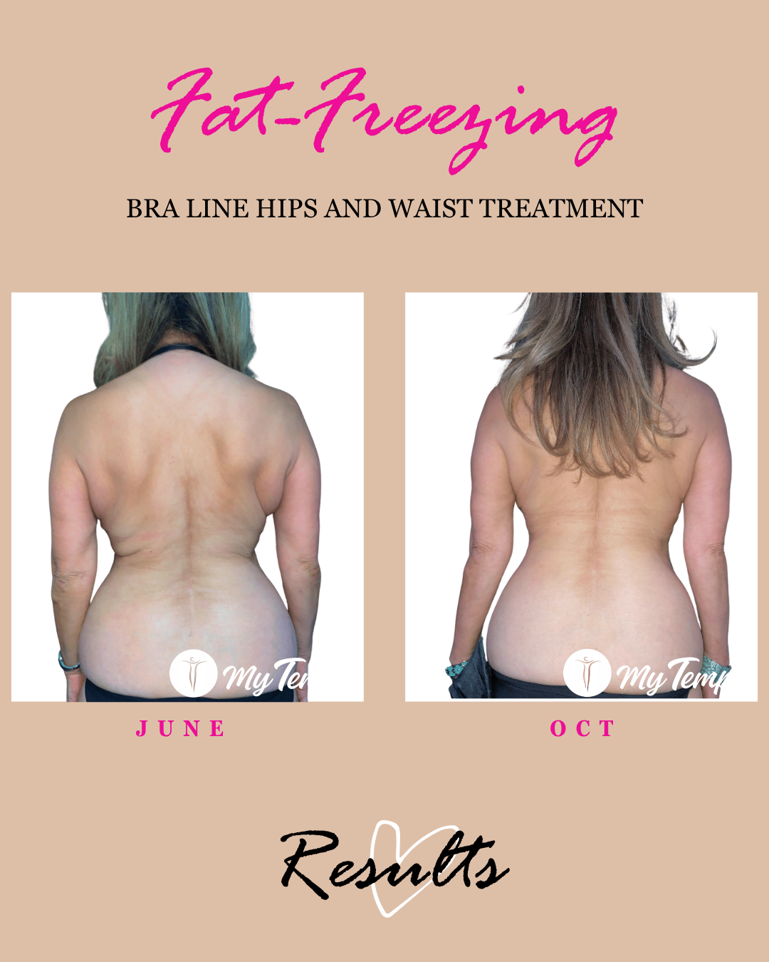 wasit and hips and braline fat freezing results