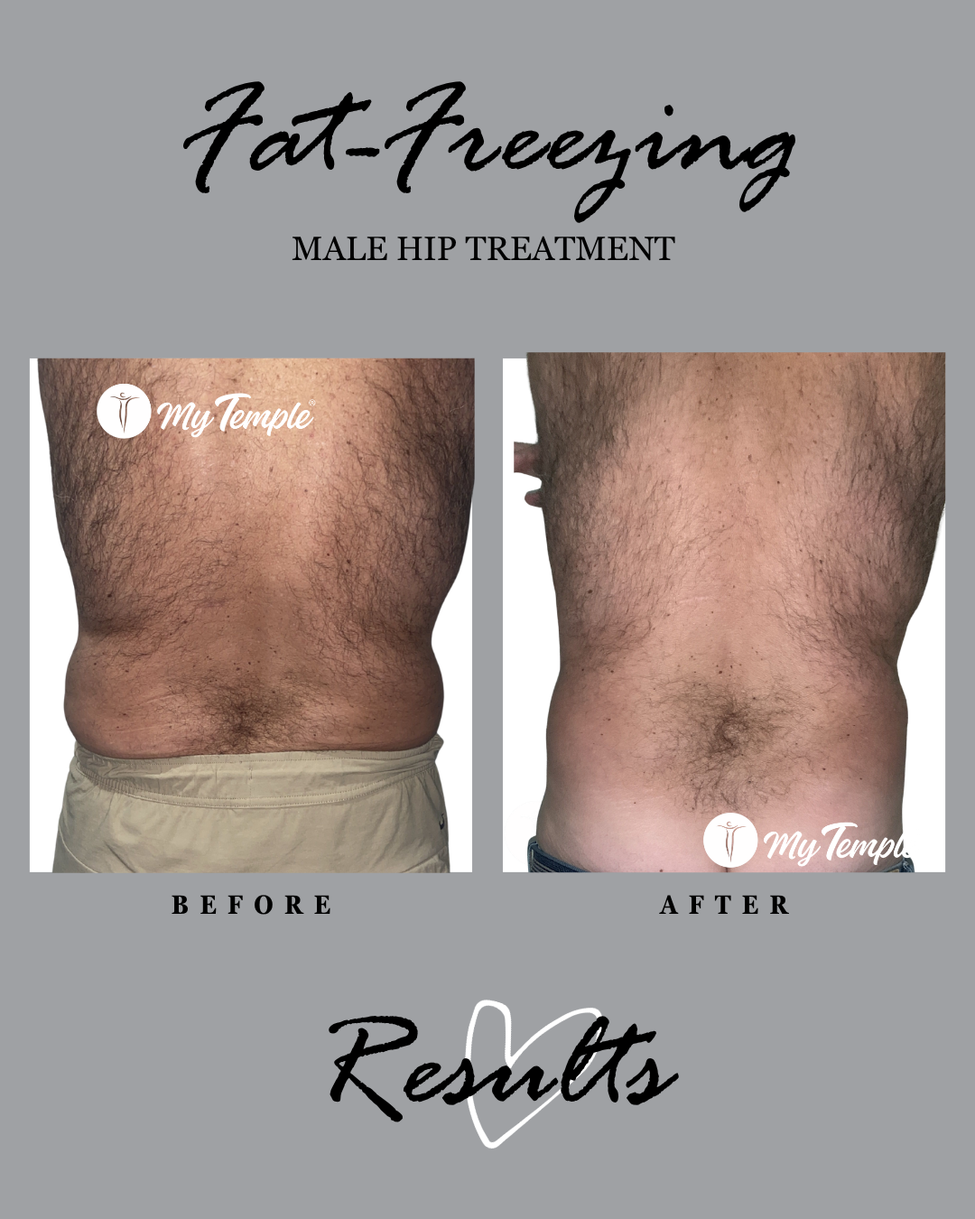 Fat freezing results: male hip, back view before and after.