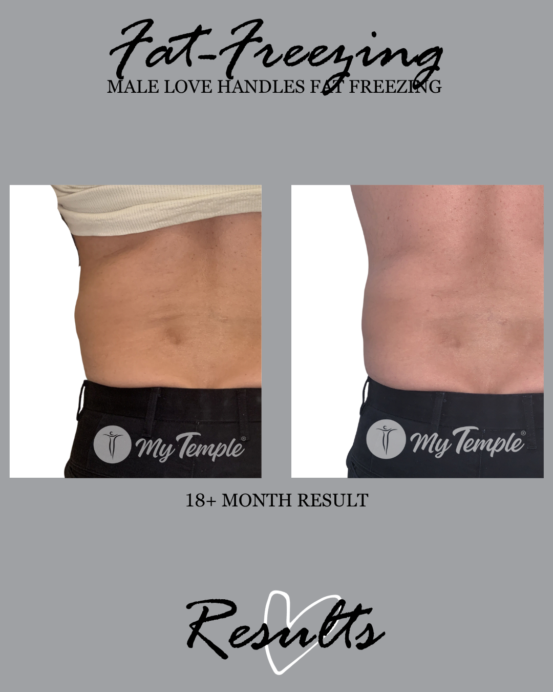 male hip fat freezing