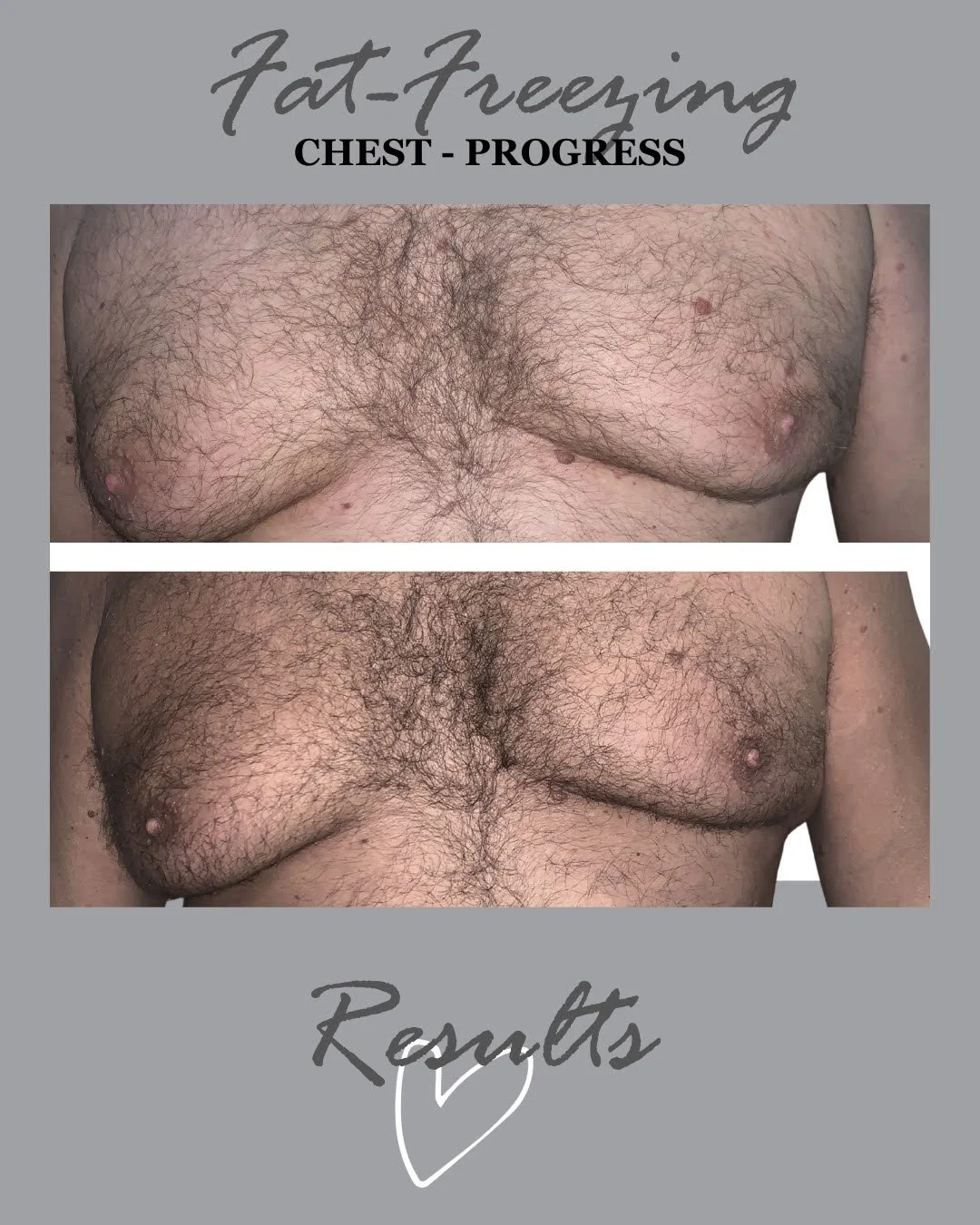 man boobs fat freezing