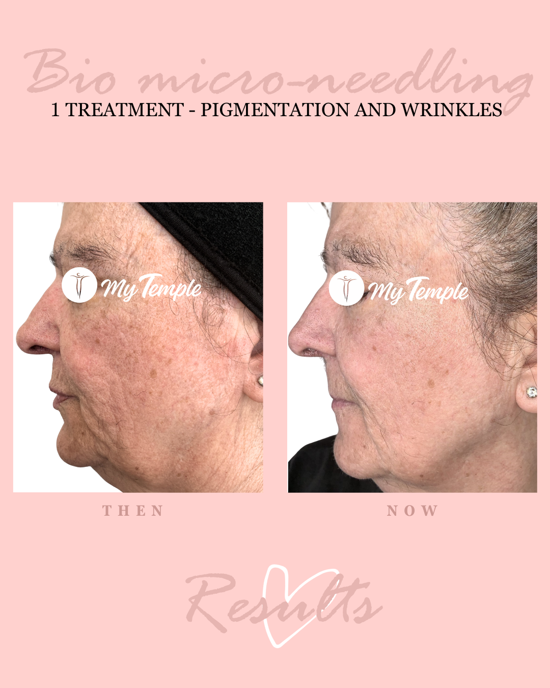 Bio-micro-needling using marine plant spicules for brighter, firmer, clearer skin