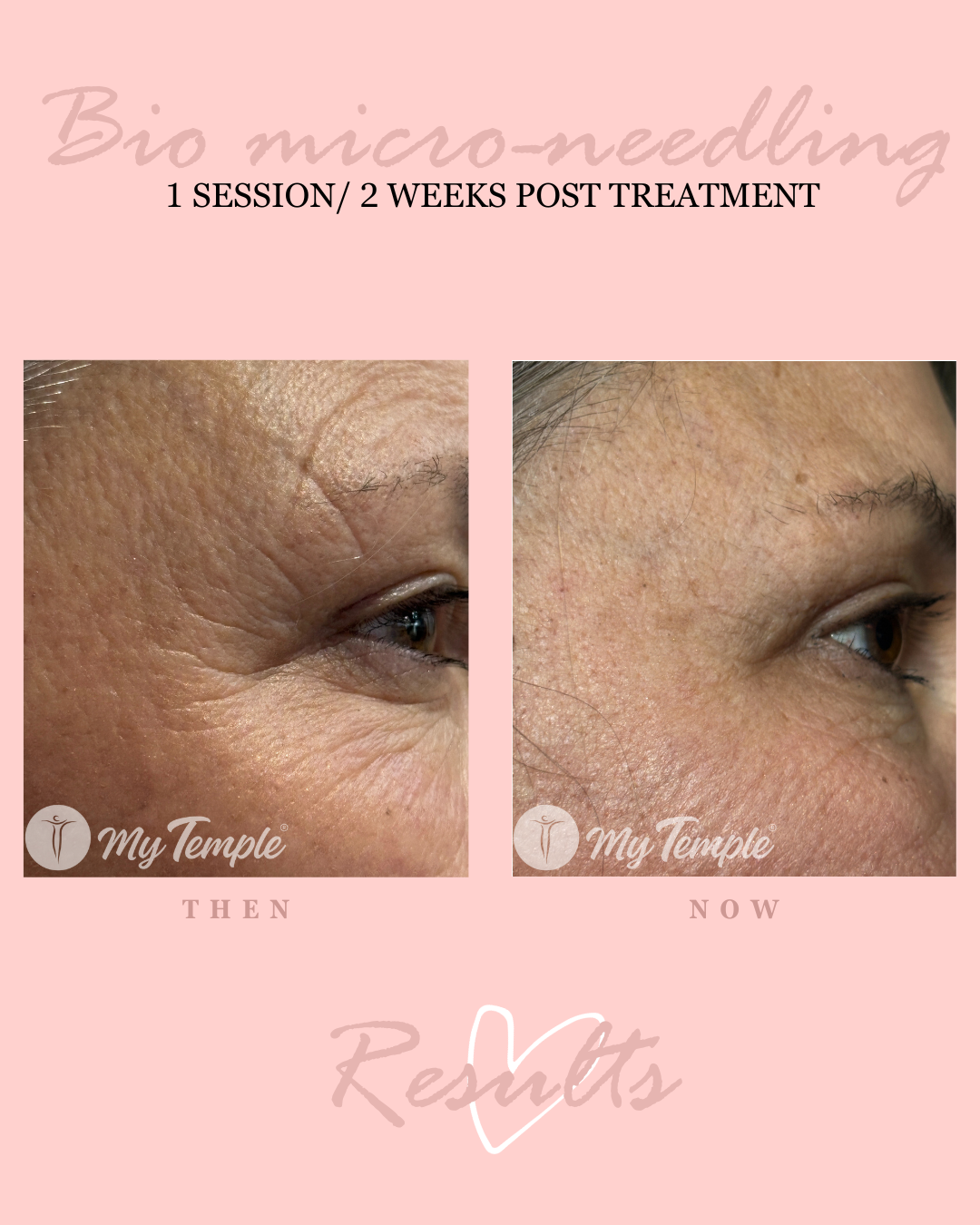 Non-invasive microneedling alternative for fine lines and dull skin