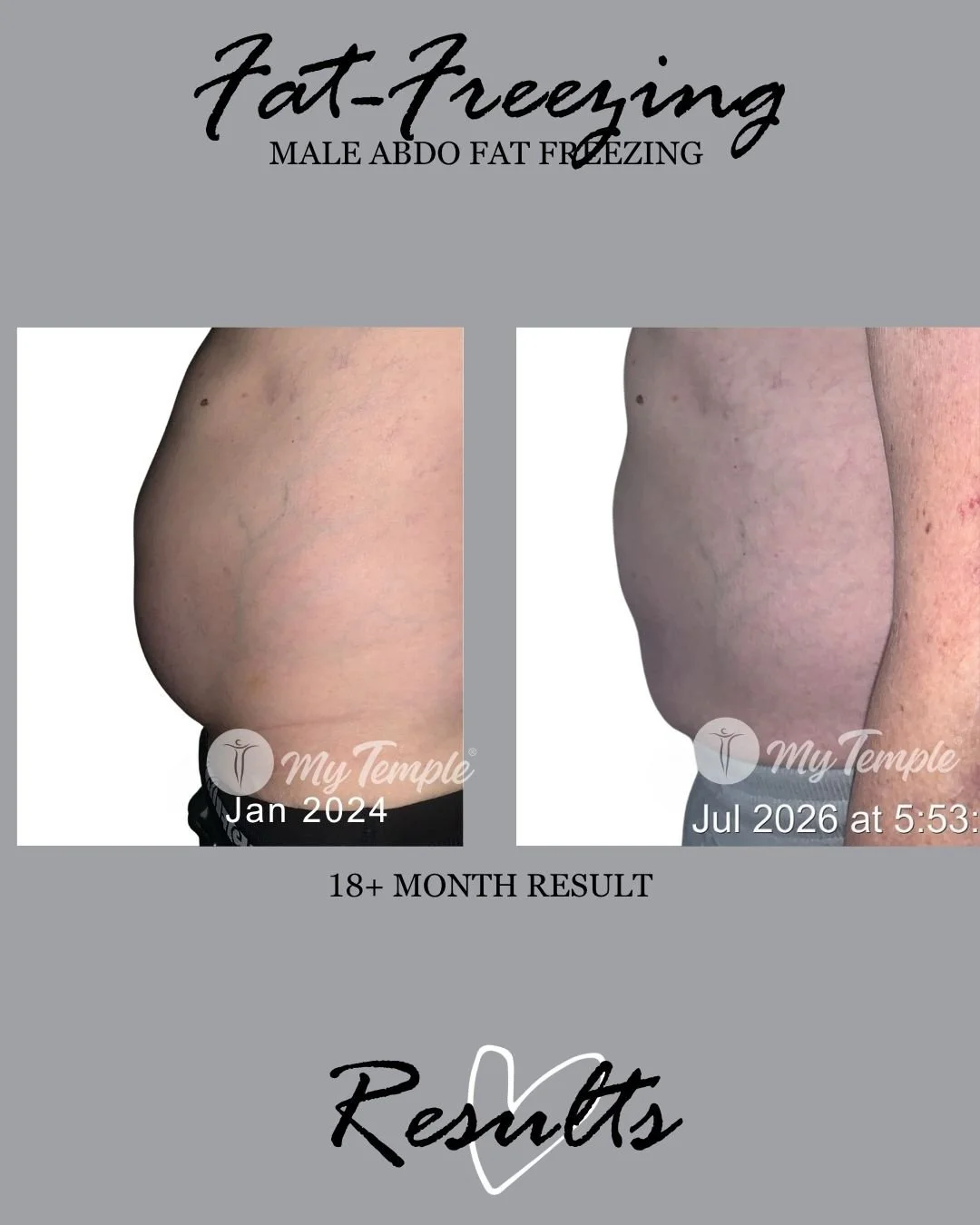 male abdomen fat freezing result