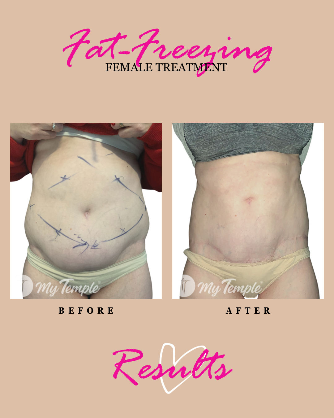 FAT FREEZING ON WOMENS BELLY 