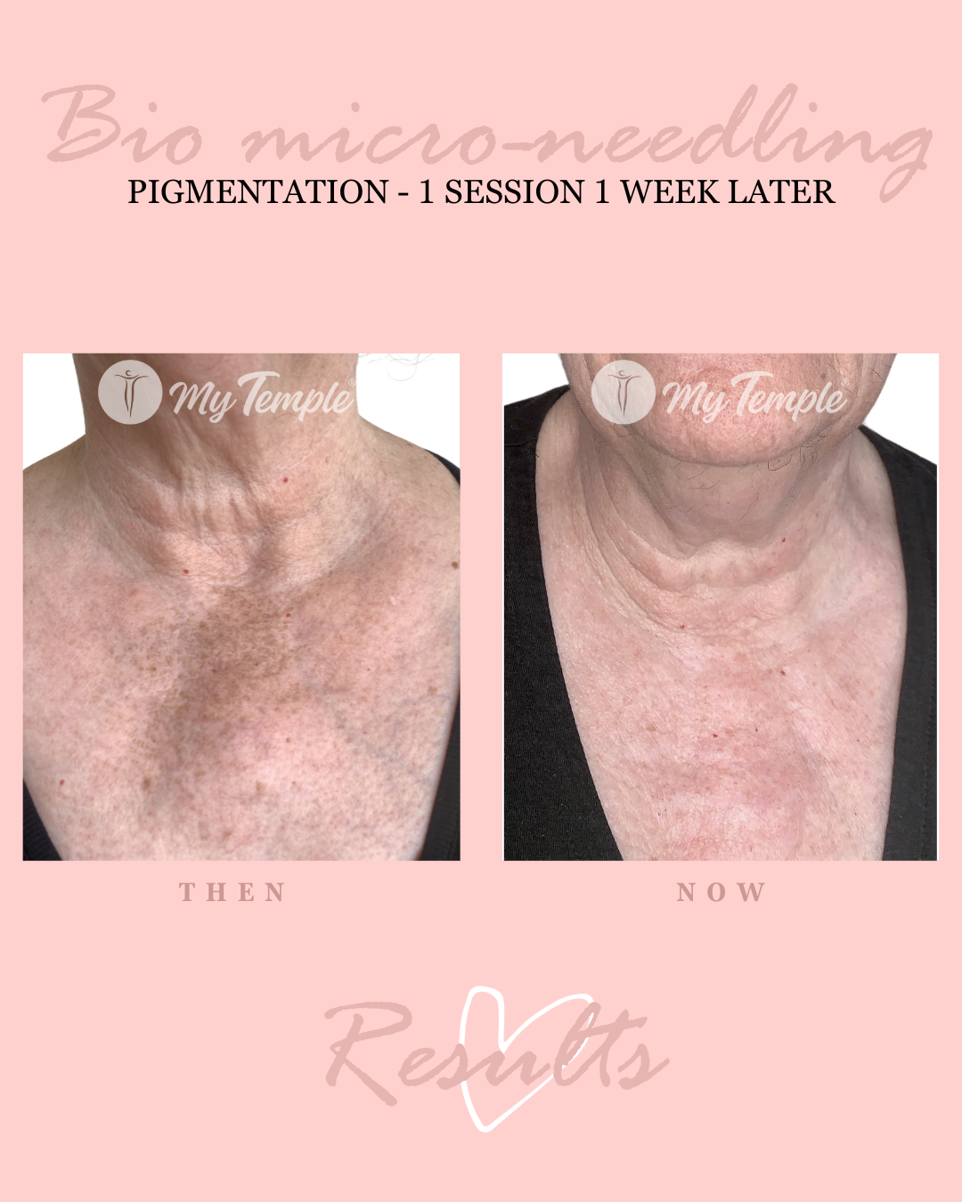 Spicule microneedling without needles for acne scars, pigmentation, and fine lines