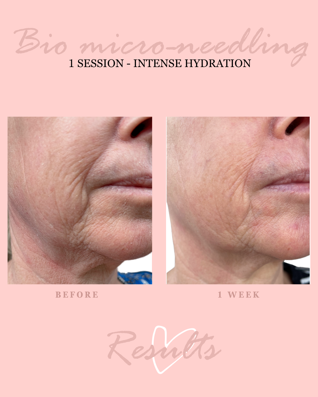 Bio microneedling for sensitive skin and all Fitzpatrick skin types
