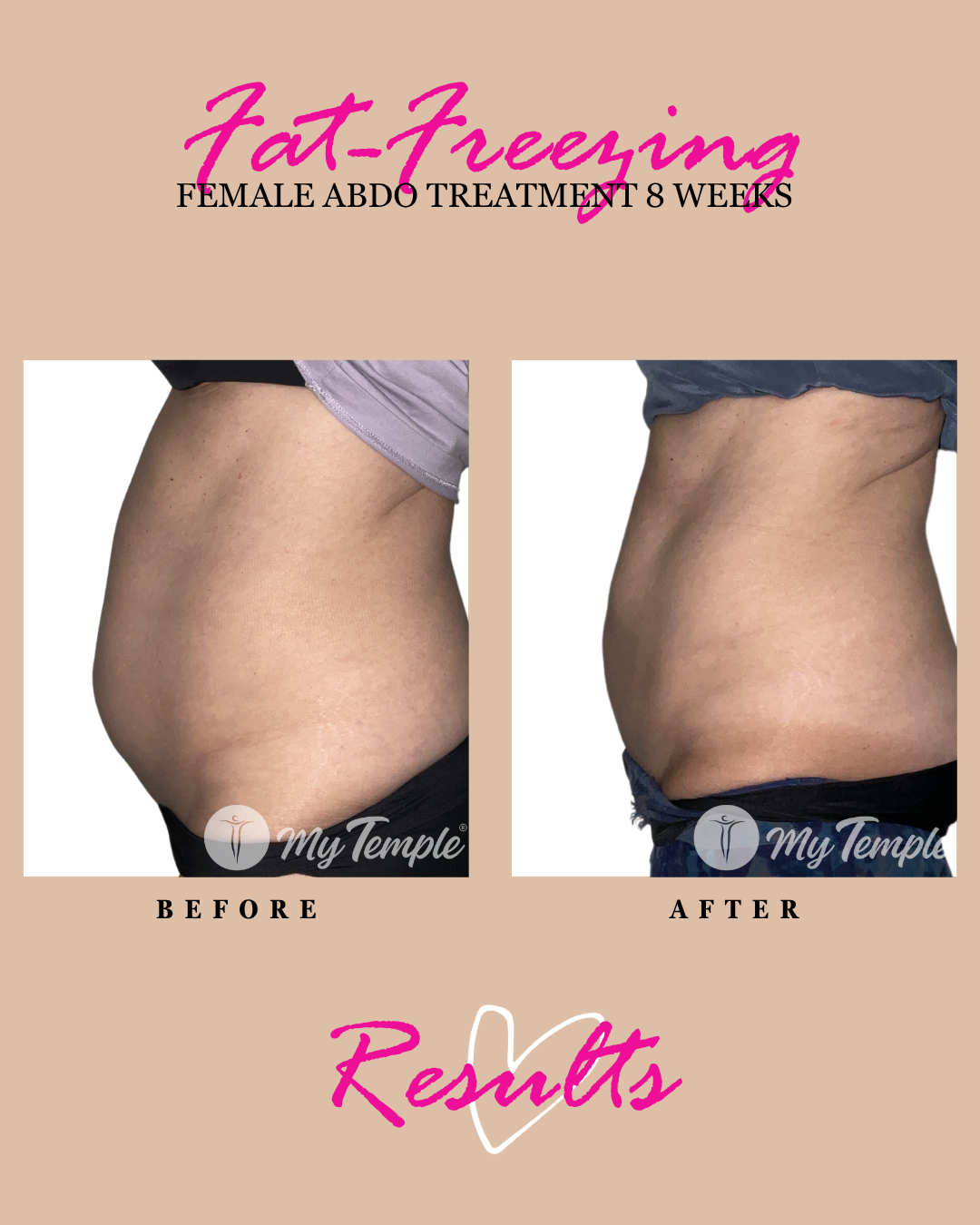 Fat freezing results: female abdomen, 8 weeks post treatment.