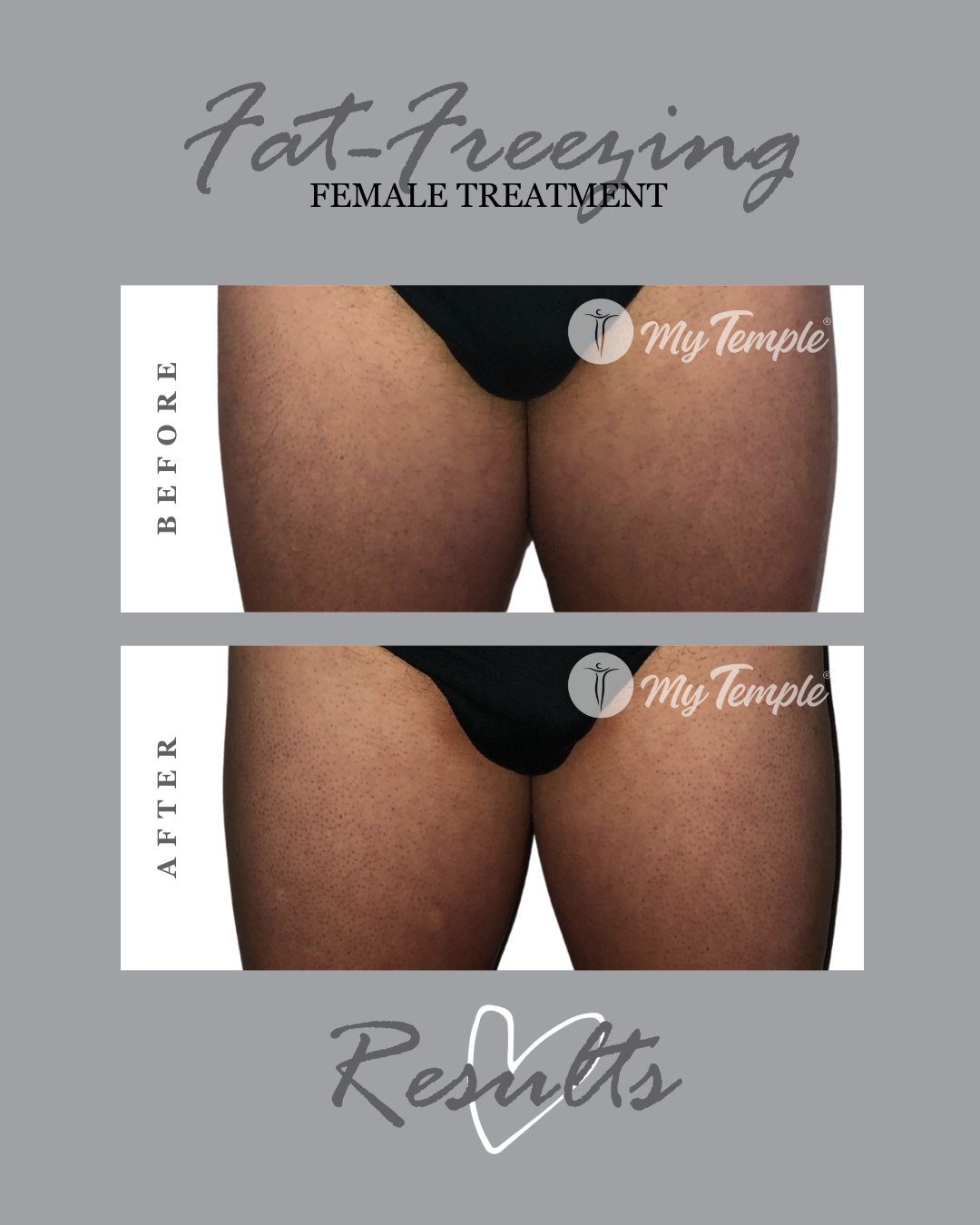 _AM male inner thighs 4x5 (1).png
