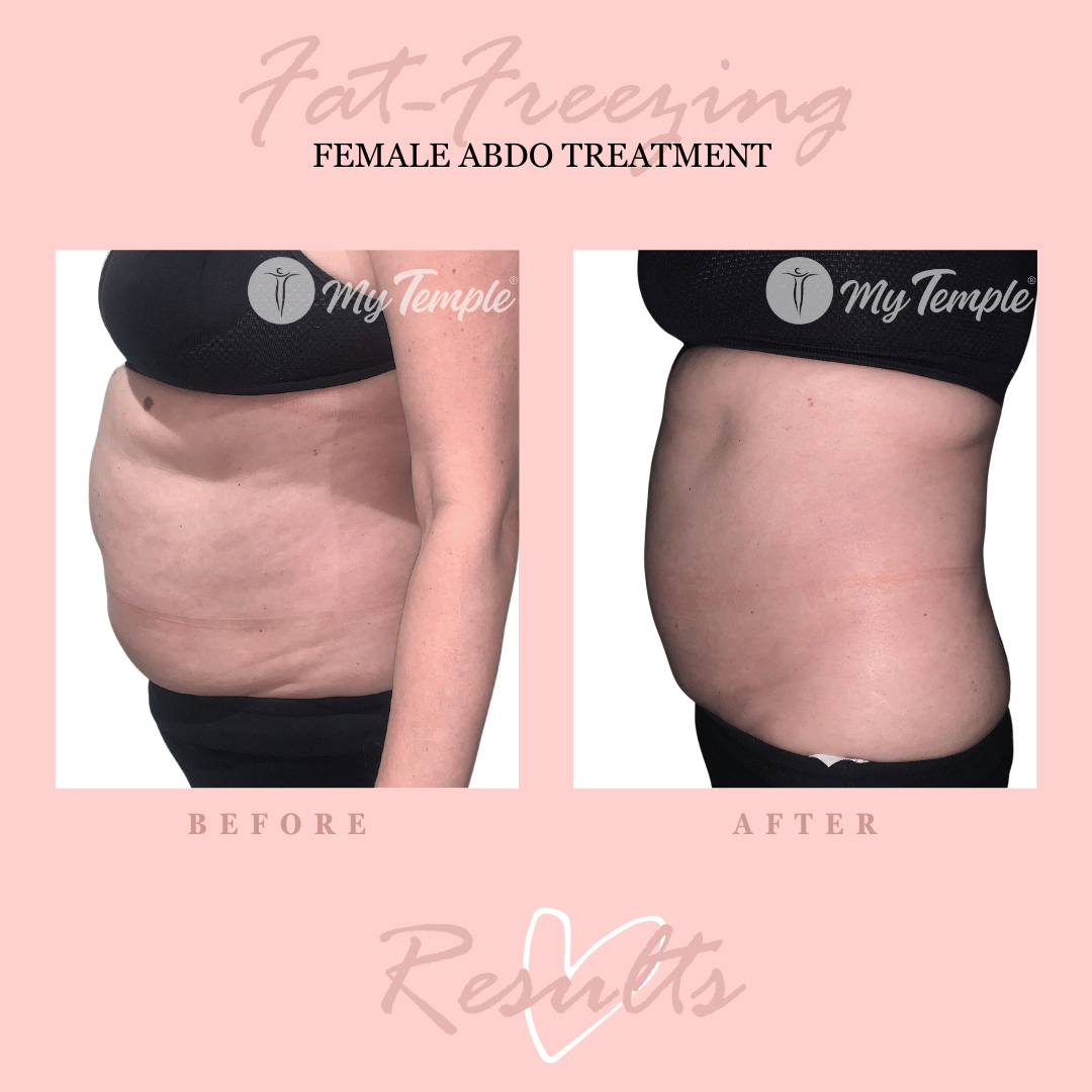 Trudy R abdo treatment (1).png
