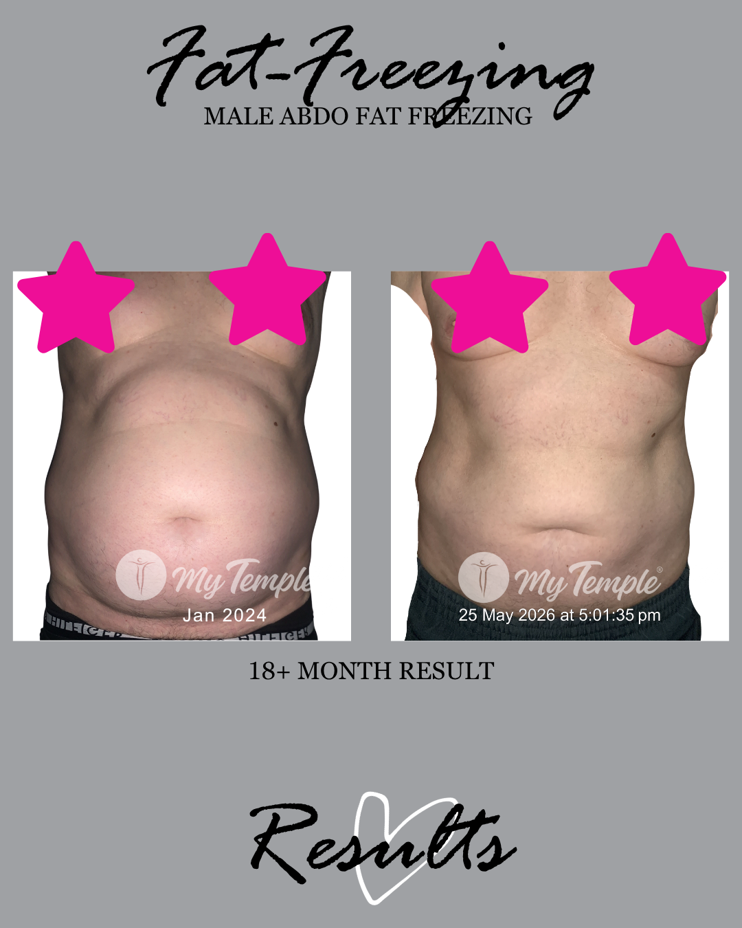 Male stomach fat freezing before and after results 18 months after abdominal cryolipolysis treatment at My Temple Melbourne