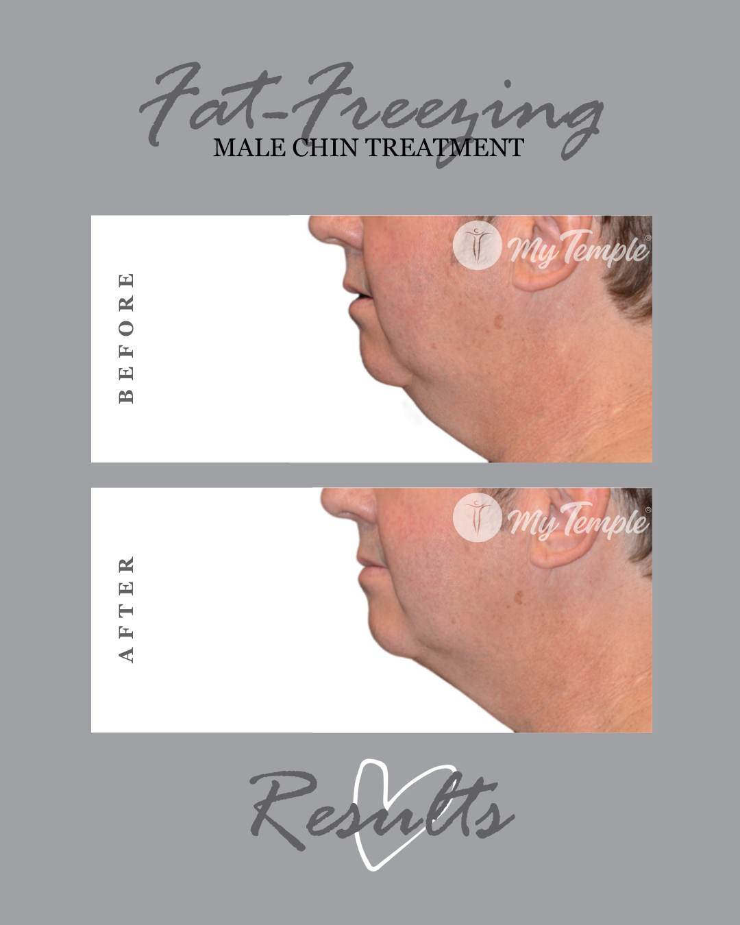 Male CHIN TREATMENT 4x5.png