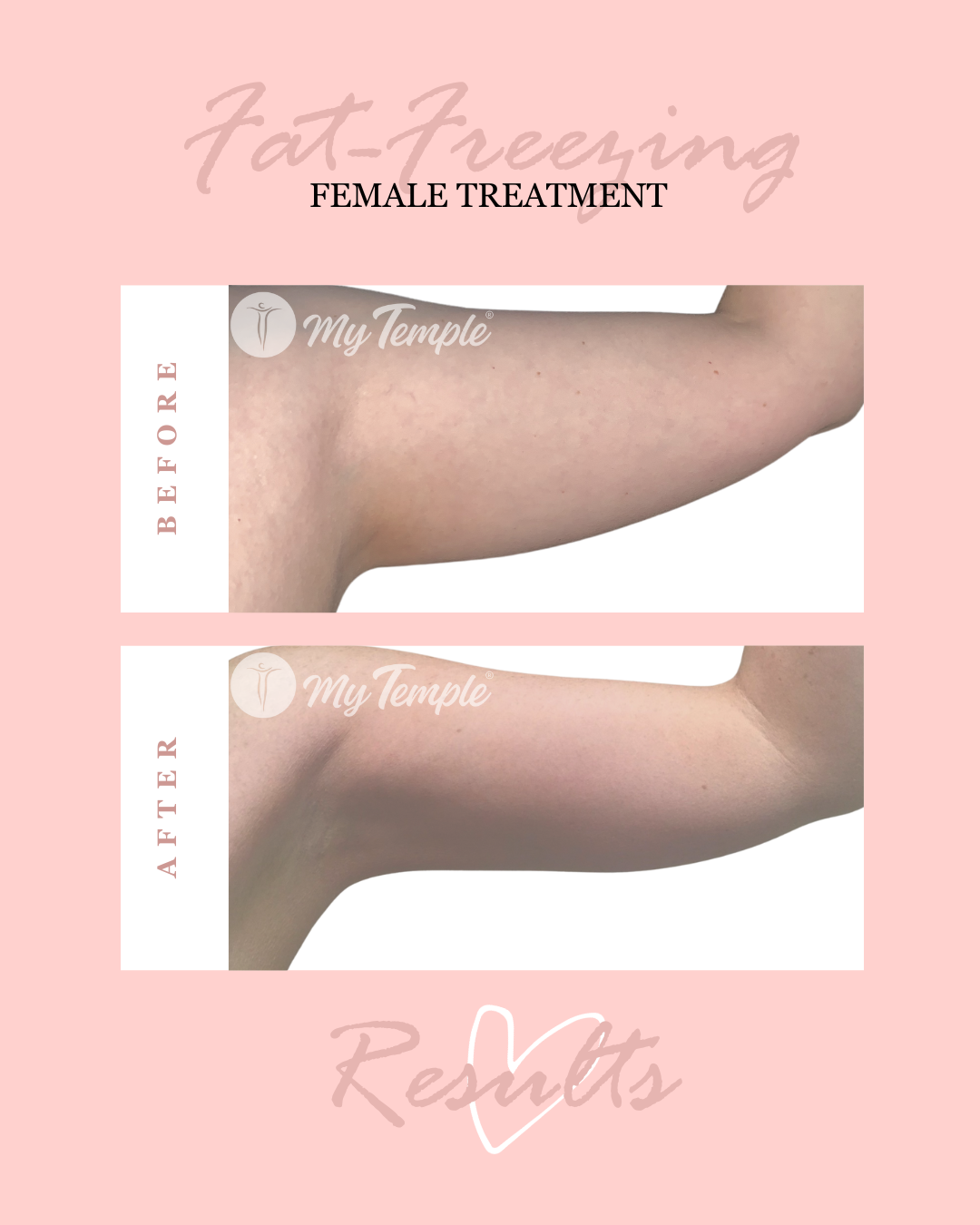 Fat freezing results on female under arms