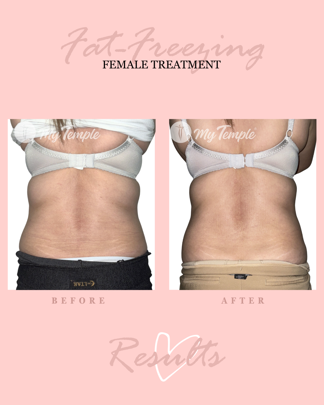 FH abdo hips bra 4x5.png