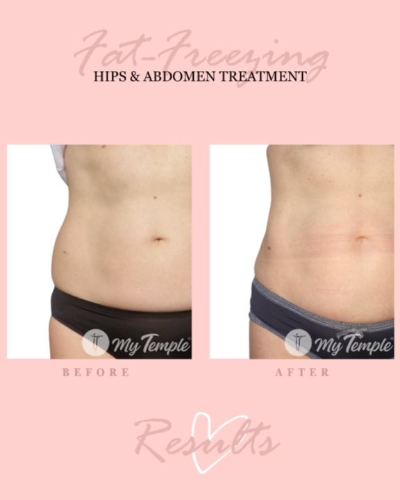 Female hips fat freezing/ cryolipolysis results before and after