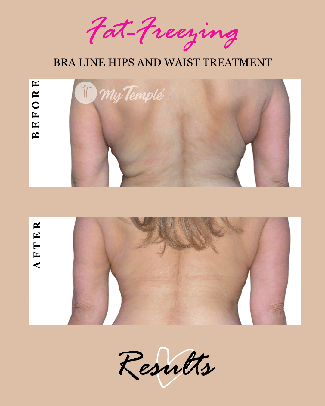 womens bra fat freezing