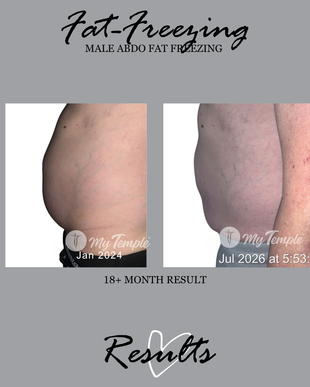 Male stomach fat freezing before and after results 18 months after abdominal cryolipolysis treatment at My Temple Melbourne