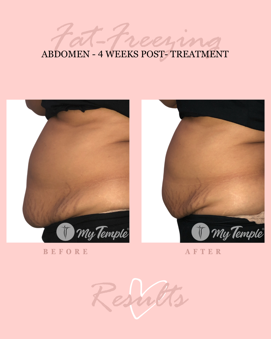 Fat freezing results on female lower abdomen/ belly buldge 4 weeks after treatment