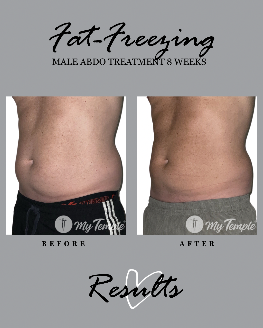 FAT FREEZING ON MENS HIPS AND ABDOMEN
