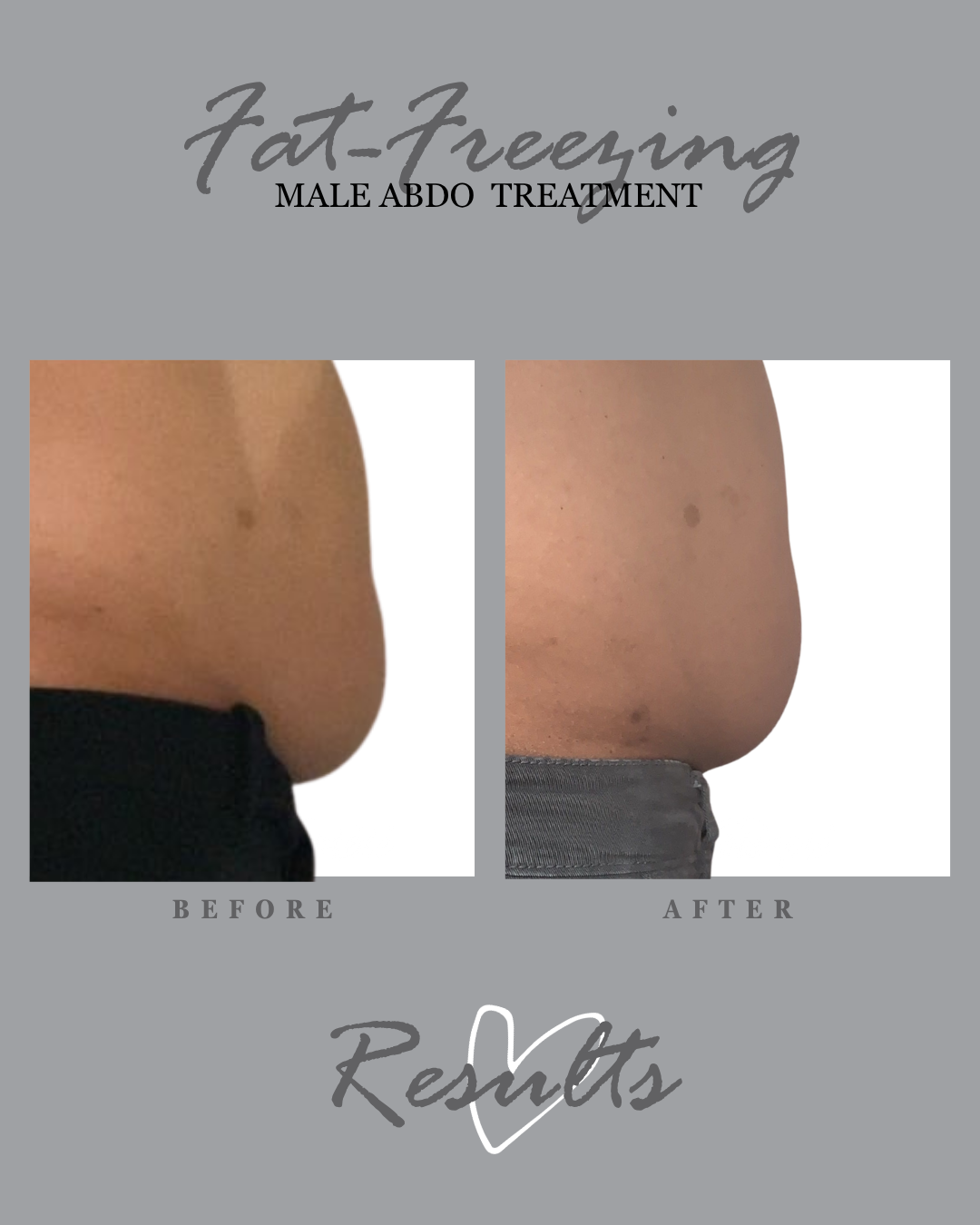 Fat freezing results: male abdomen, before and after.