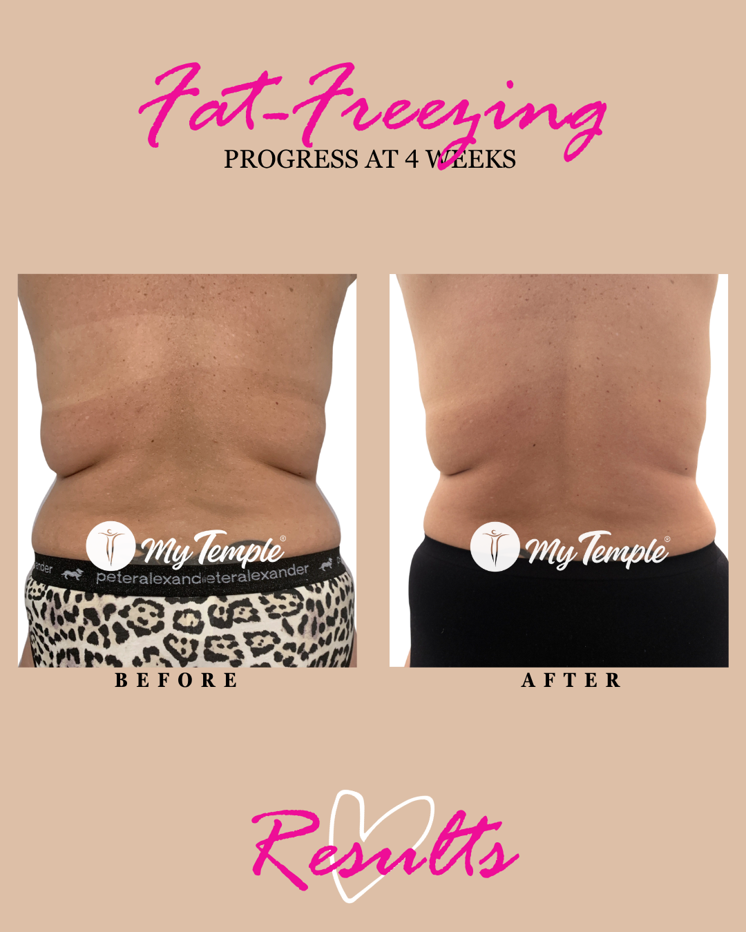 N C bra line progress @ 4 weeks 4x5  - 1.png