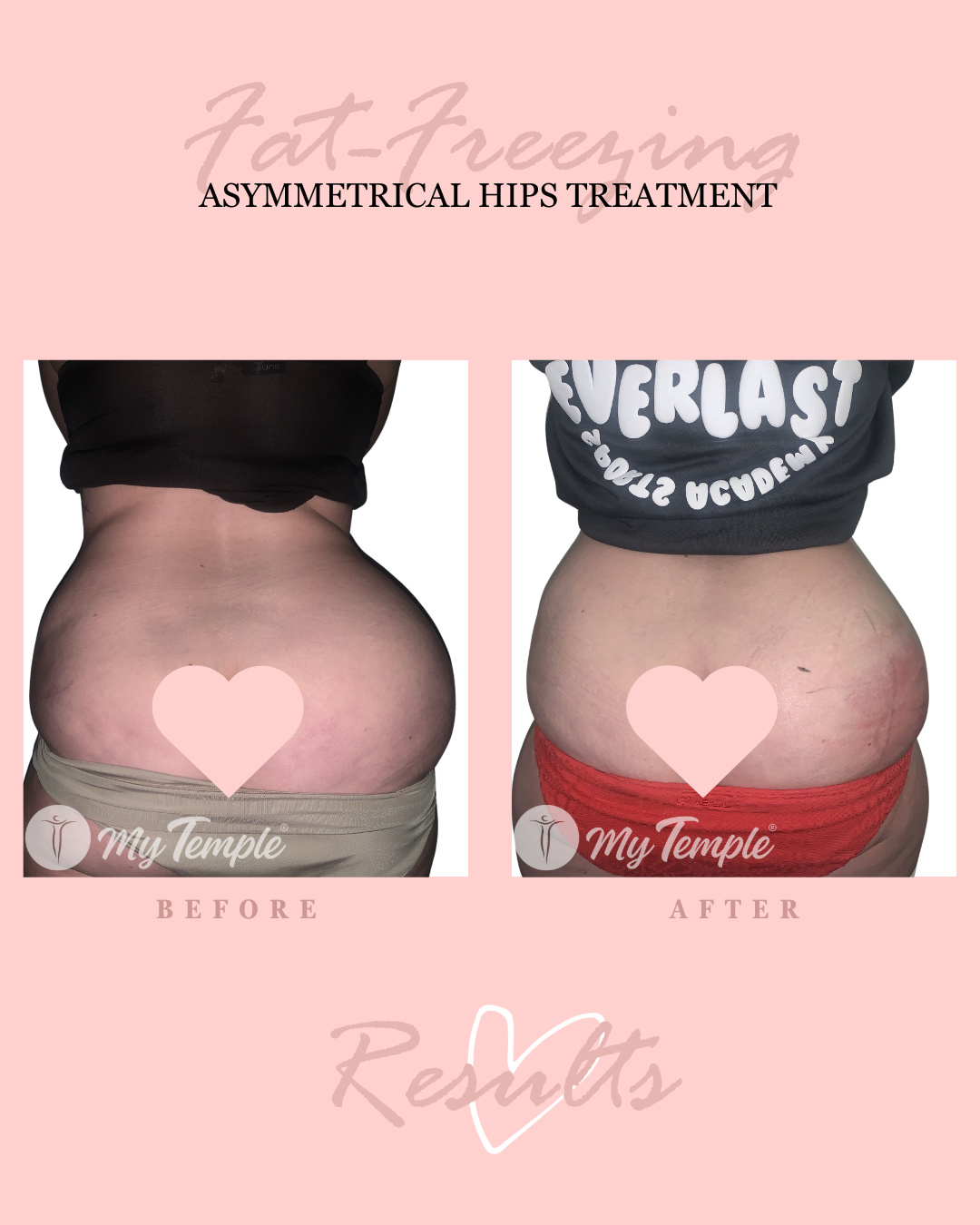 RG Asymmetrical hips 4x5 .png