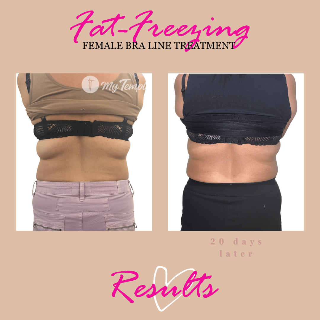  fat freezing results on bra line at 3 weeks