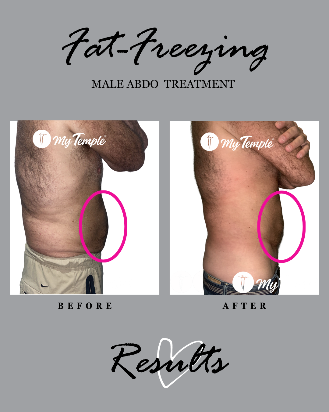 Fat freezing results: male abdomen, side view before and after.