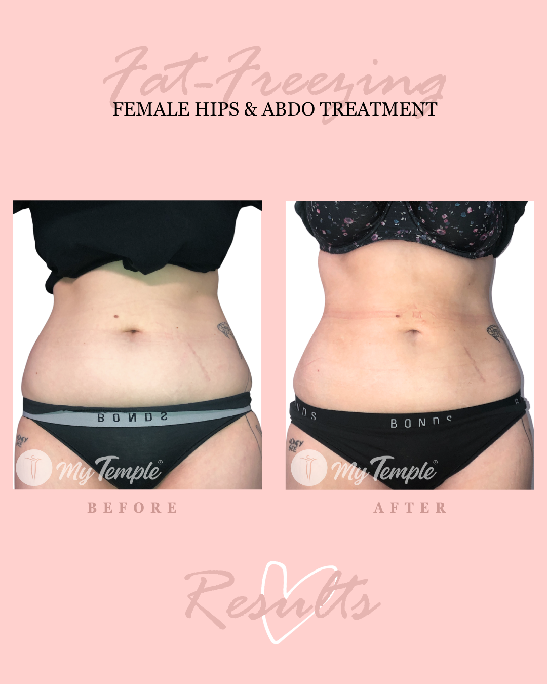 BD 2 hips & 2 abdo - results at 10 wks 4x5.png
