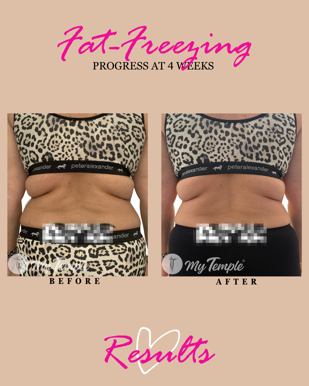 N C bra line progress @ 4 weeks 4x5  - 9.png