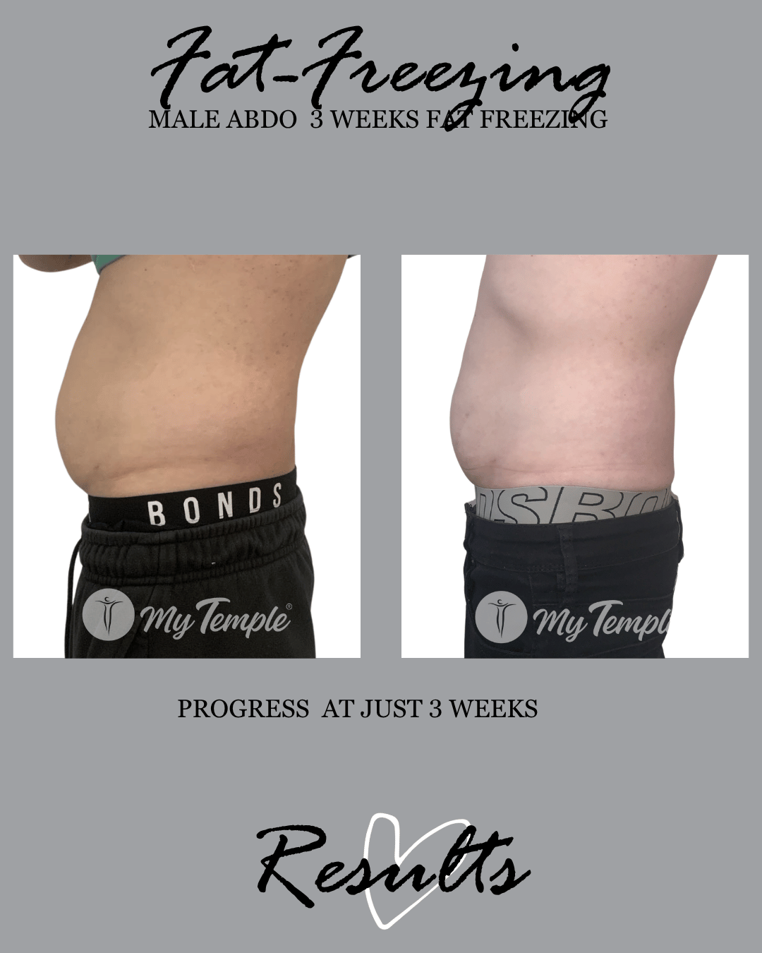 3 weeks fat freezing result male stomach
