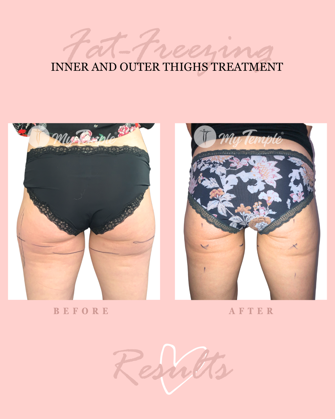 VK inner and outer thighs 4x5 (1).png